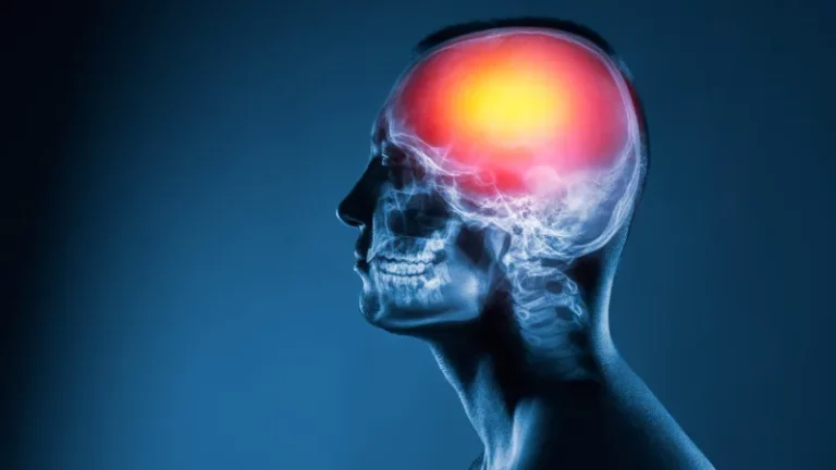 ¿Por qué aumentan los accidentes cerebrovasculares entre los jóvenes