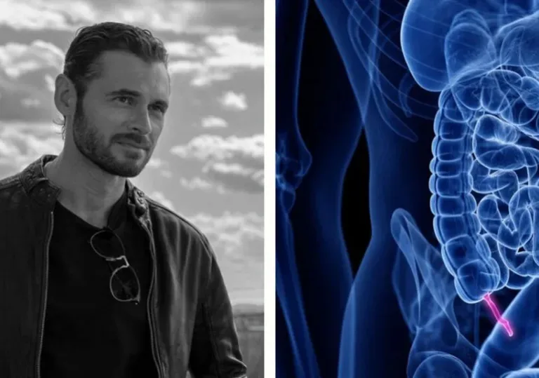 El cáncer de apéndice: síntomas, diagnóstico y avances en el tratamiento
