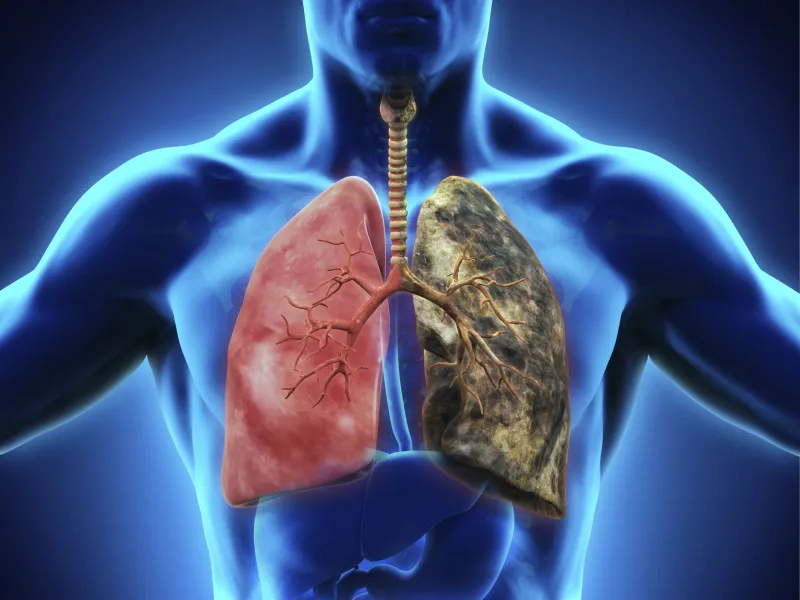 El cáncer de pulmón vuelve a ser el más común en el mundo y se mantiene como el más mortal