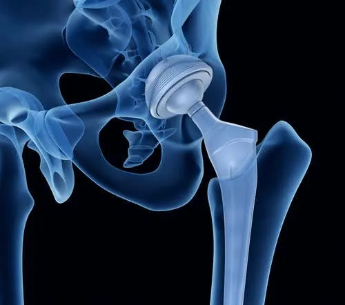 Problemas presentes en la articulación de la cadera