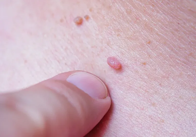Vacuna contra el virus del papiloma humano y cáncer en urología