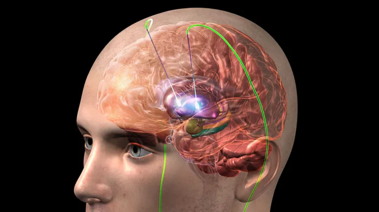 Durante-la-estimulacion-cerebral-profunda-se-implantan-electrodos-en-el-cerebro.jpg