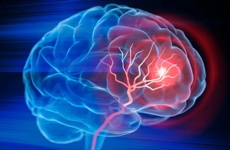 ¿Por qué el derrame cerebral es diferente para las mujeres? Conoce las claves