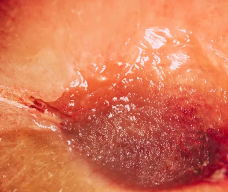 Estudio: Una de cada cinco personas de entre 15 y 49 años padece herpes genital