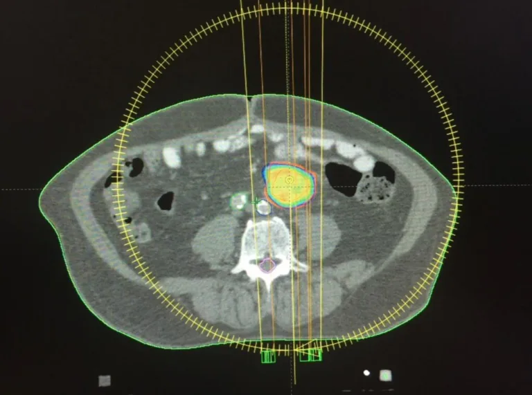 Radiocirugia-intracraneal-1024x761.jpg