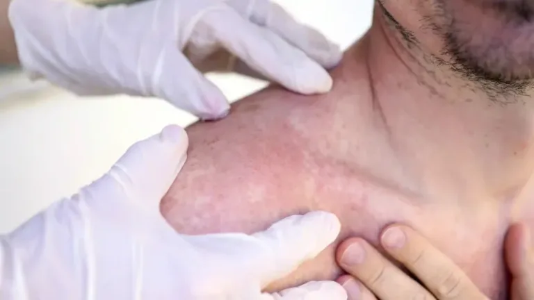 Pacientes con enfermedades dermatológicas tienen más probabilidades de tener problemas mentales