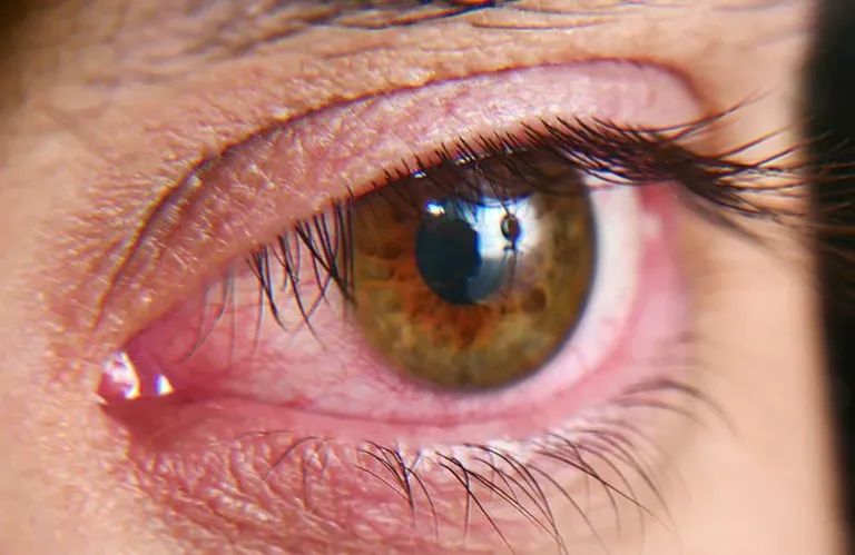 El ojo seco: una molestia cotidiana que puede convertirse en una condición crónica