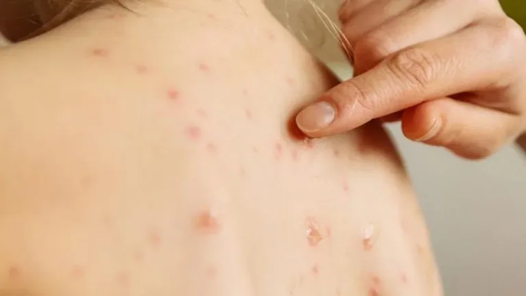 Confirman un caso de sarampión en Paraguay tras diez años sin circulación del virus