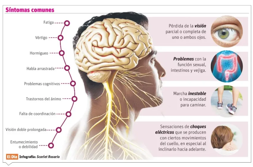 Esclerosis múltiple, una enfermedad sin cura, con múltiples tratamientos