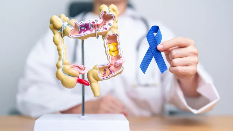 Factores del cáncer colorrectal de aparición temprana podrían originarse en la infancia
