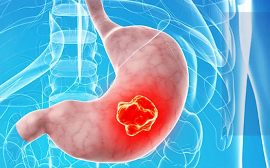 Dominicana impulsa trasplante médula ósea cáncer pediátrico