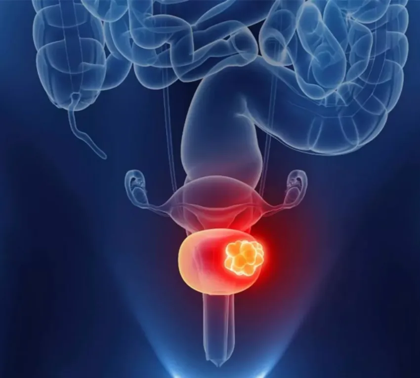 Por qué los hombres y fumadores tienen mayor riesgo de sufrir cáncer de vejiga