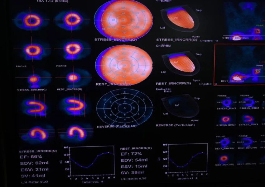 CEDIMAT realiza gammagrafía cardíaca con Regadenoson