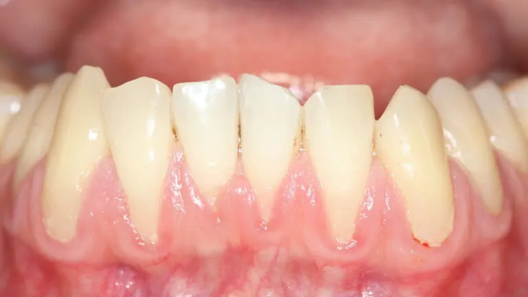 ¿Qué son las encías retraídas y por qué ocurren?