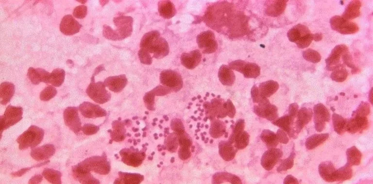 Estudio demuestra que la sífilis ya existía en América hace miles de años