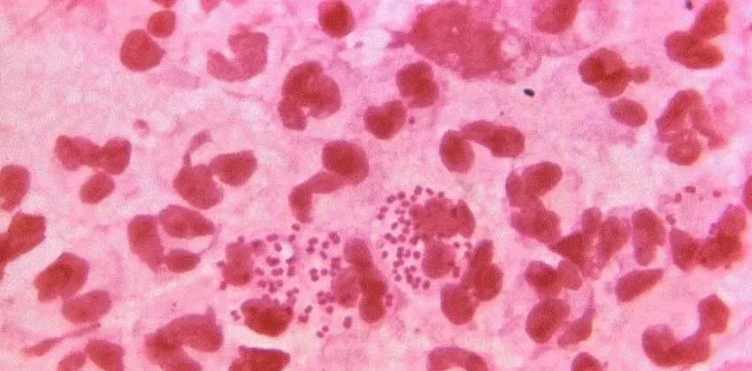 Estudio demuestra que la sífilis ya existía en América hace miles de años