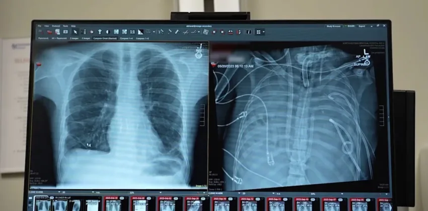 Un sistema de respiración artificial mantiene vivo a un paciente hasta el trasplante