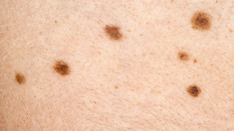 Dermatóloga advierte sobre el aumento del cáncer de piel