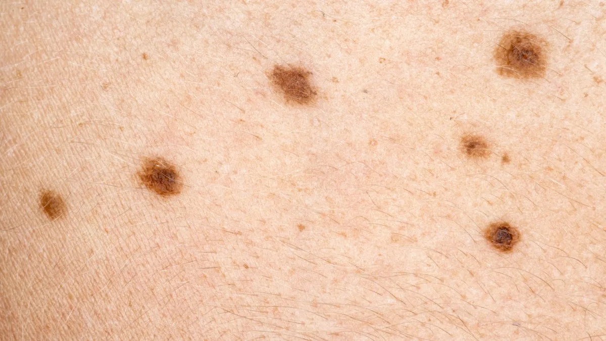 Dermatóloga advierte sobre el aumento del cáncer de piel