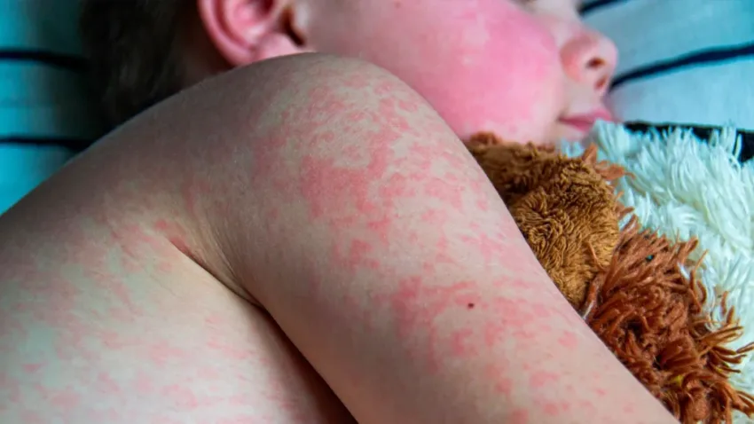 Estados Unidos reporta alrededor de 700 casos de sarampión en lo que va de año
