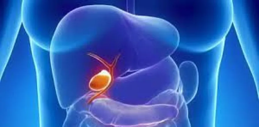 Qué es el colangiocarcinoma: síntomas, causas y tratamiento