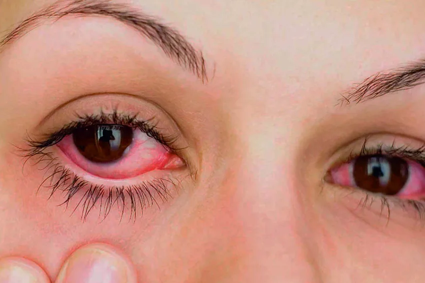 Ojos rojos y picazón: cómo diferenciar entre conjuntivitis y alergia ocular
