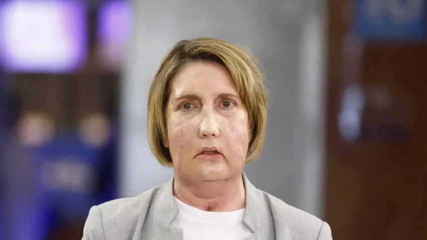 Hospital de Barcelona hace el primer trasplante facial del mundo con donante que recibió la eutanasia