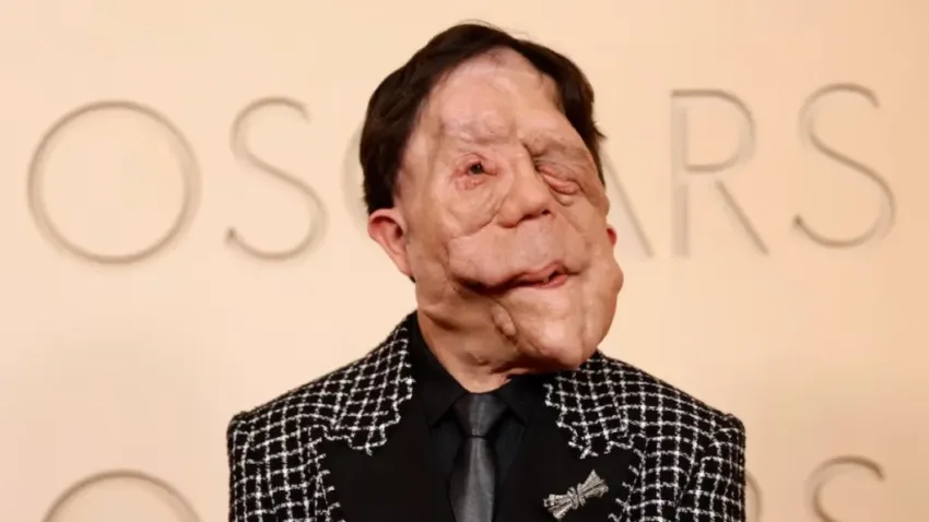 Qué es la neurofibromatosis, la enfermedad que padece el actor Adam Pearson