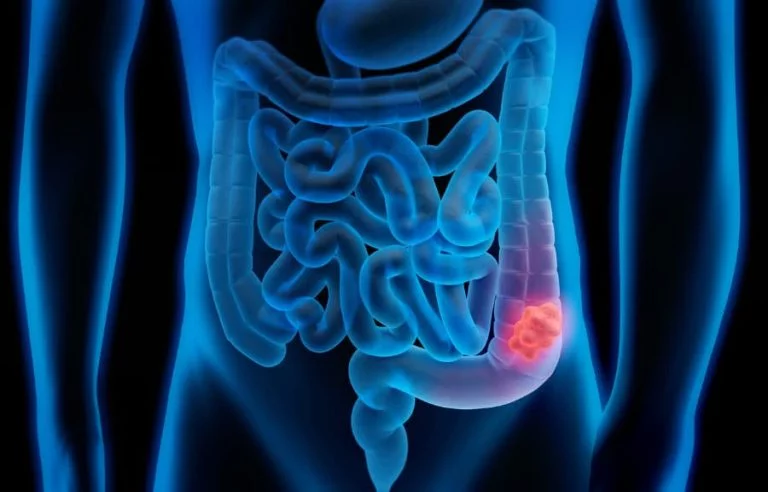 Cáncer de colon: detectarlo a tiempo salva hasta el 90 % de los pacientes