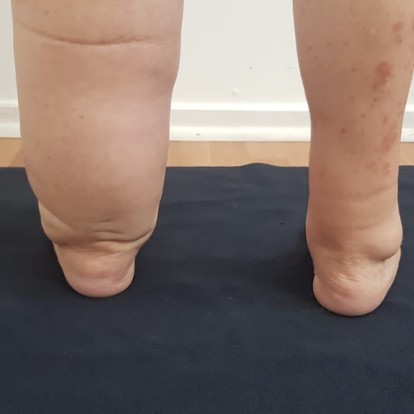 Hoy se conmemora Día del Linfedema, complicación dolorosa del cáncer