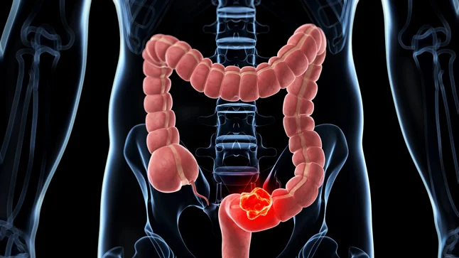 El riesgo de cáncer de colon se duplica con antecedentes familiares o mutaciones genéticas, afirman los expertos