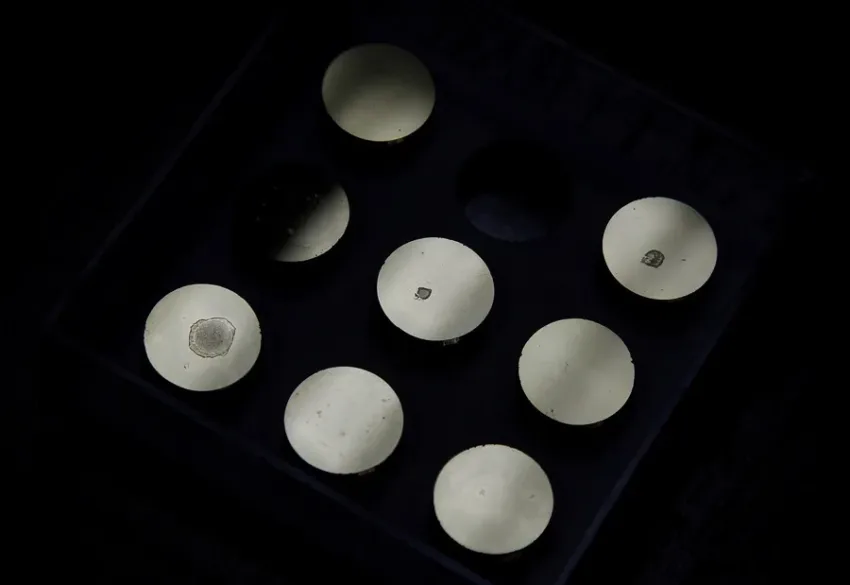 Detectan el primer caso de transmisión de una enfermedad rara mediante donante de esperma