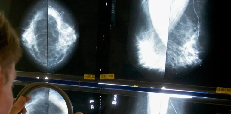 ¿Cuándo hacerse mamografías? Confusión entre guías de salud sobre detección de cáncer de mama