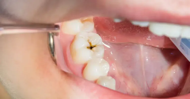 Cuáles son los errores comunes que elevan el riesgo de tener caries dentales
