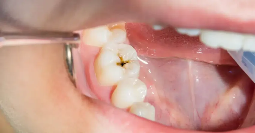 Cuáles son los errores comunes que elevan el riesgo de tener caries dentales
