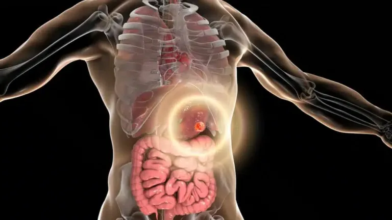 Síntomas que alertan sobre un cáncer de estómago en etapas tempranas
