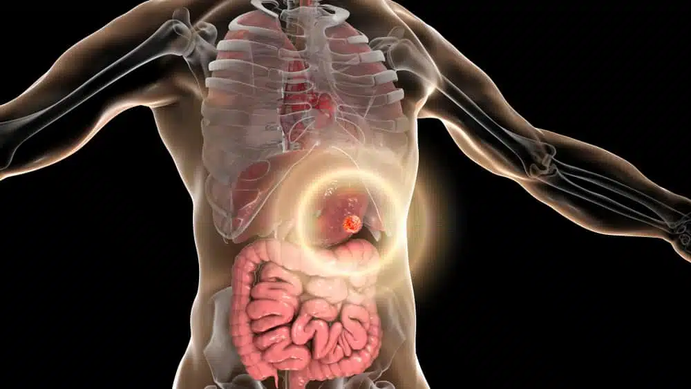 Síntomas que alertan sobre un cáncer de estómago en etapas tempranas