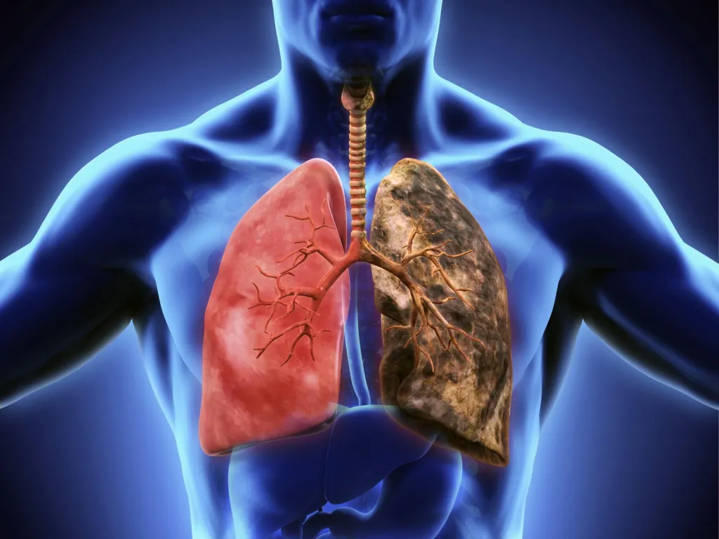 Sociedad Oncología dice 80% cáncer pulmón se asocia tabaco