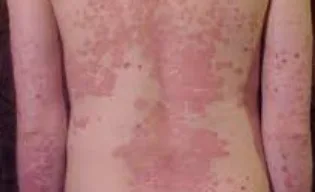 Psoriasis: Enfermedad crónica que afecta más allá de la piel