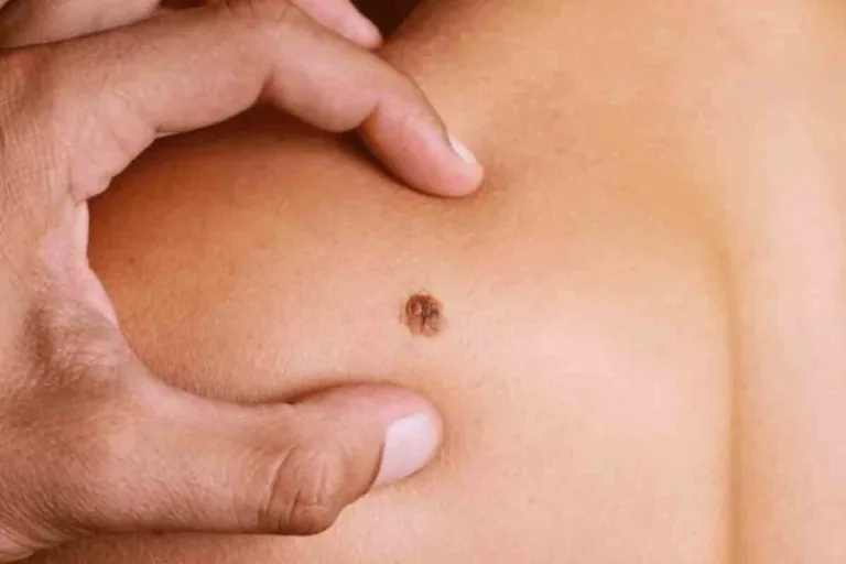 Salud llama a detectar a tiempo el sarcoma, cáncer poco frecuente que puede afectar a cualquier edad