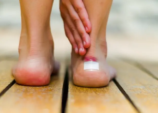 Irritación en la piel por fricción: cuidados y tratamientos