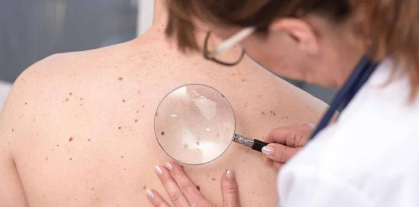Cómo prevenir el cáncer de piel ante las altas temperaturas