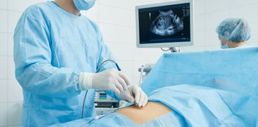 Nueva técnica permite tratar miomas uterinos sin cirugía mayor