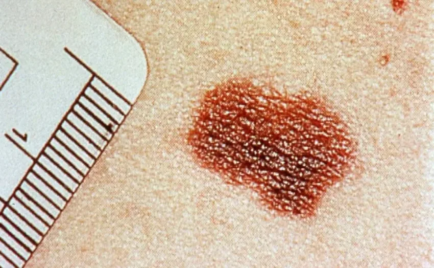 Expectación y cautela por falta de datos sobre vacuna experimental del melanoma