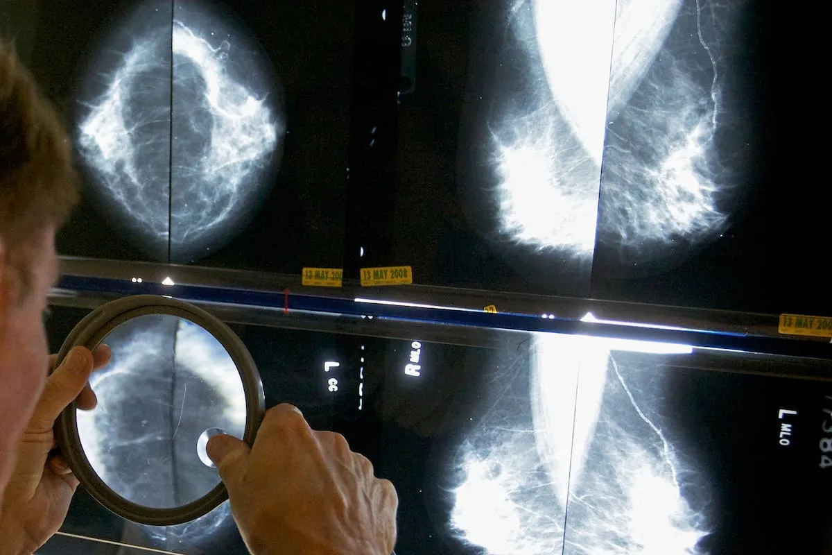 detección del cáncer mamario