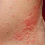Dermatitis atópica: por qué la piel puede picar tanto y qué la desencadena