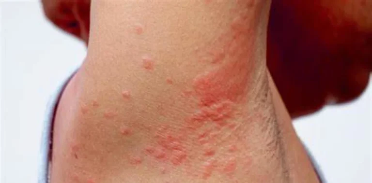 Dermatitis atópica: por qué la piel puede picar tanto y qué la desencadena