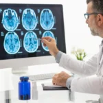 Cambios cerebrales por Alzheimer