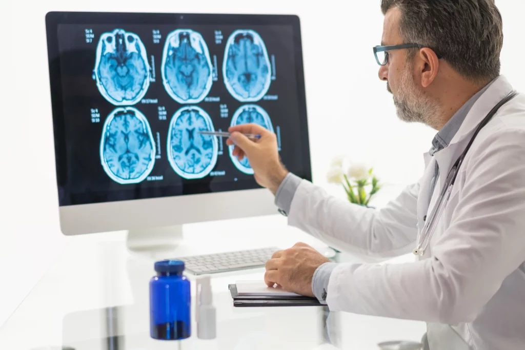 Cambios cerebrales por Alzheimer