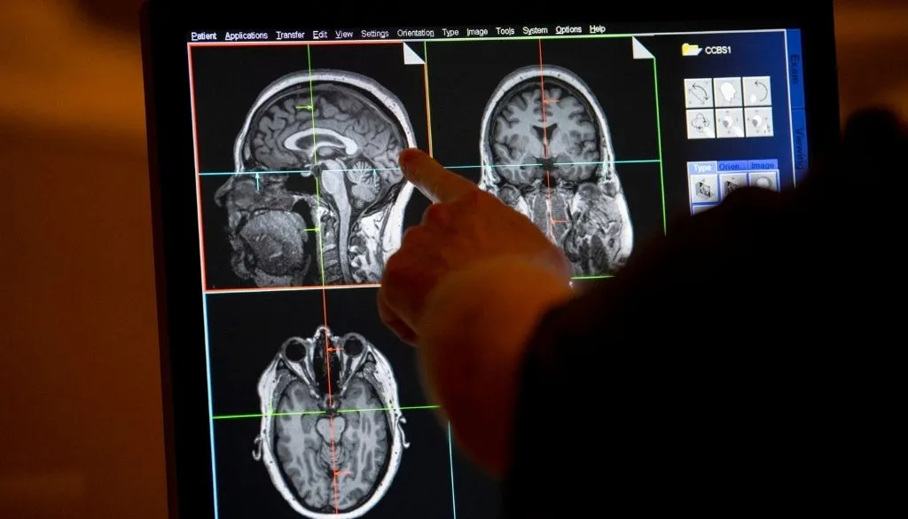Especialistas advierten diagnóstico de ataxia puede tardar más de 10 años